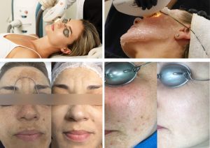 результати процедури фотоомолодження mediostar